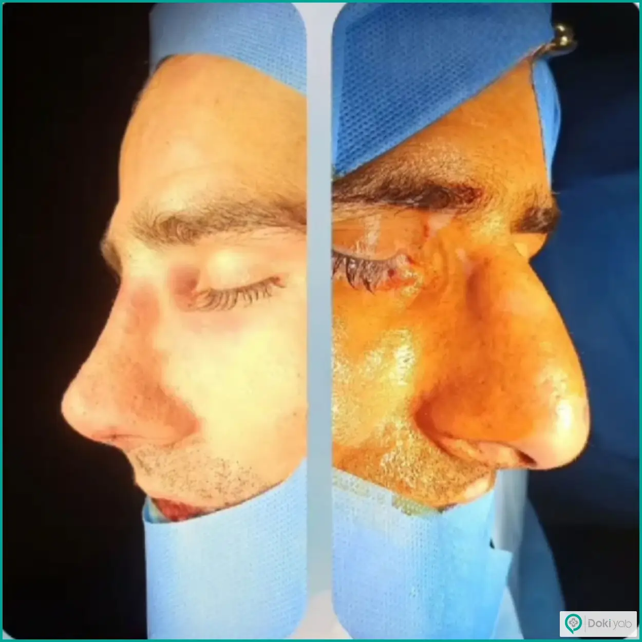 عکس قبل و بعد عمل بینی به سبک طبیعی دکتر محمدمهدی مهرابی جراح بینی در شیراز