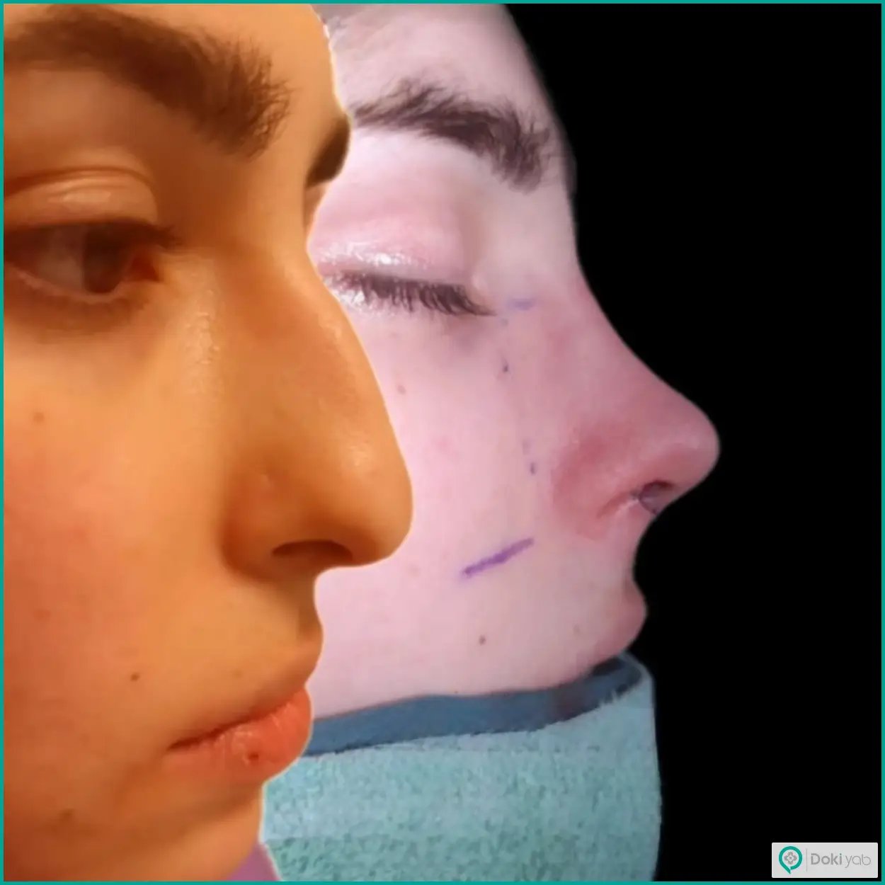 تصویر قبل و بعد از عمل بینی نیمه فانتزی دکتر محمدمهدی مهرابی جراح بینی در شیراز