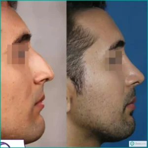 نمونه عمل بینی طبیعی دکتر فرشید شکوهی