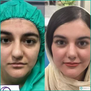 نمونه عمل بینی گوشتی دکتر فرشید شکوهی