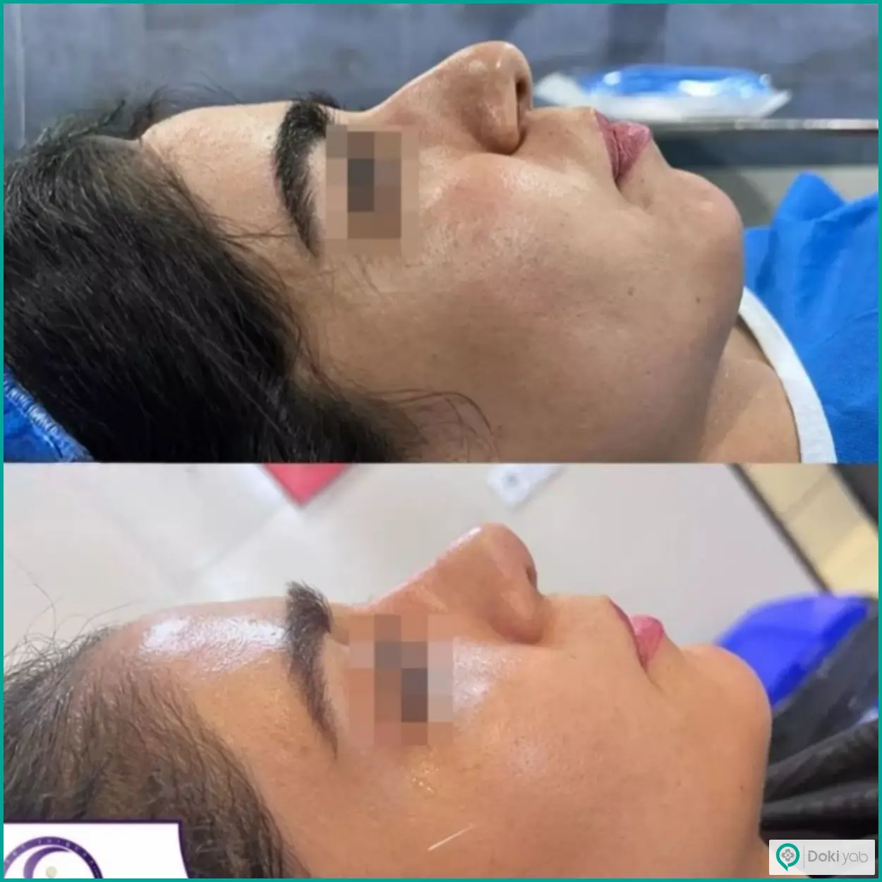 تصویر قبل و بعد جراحی بینی دکتر فرشید شکوهی