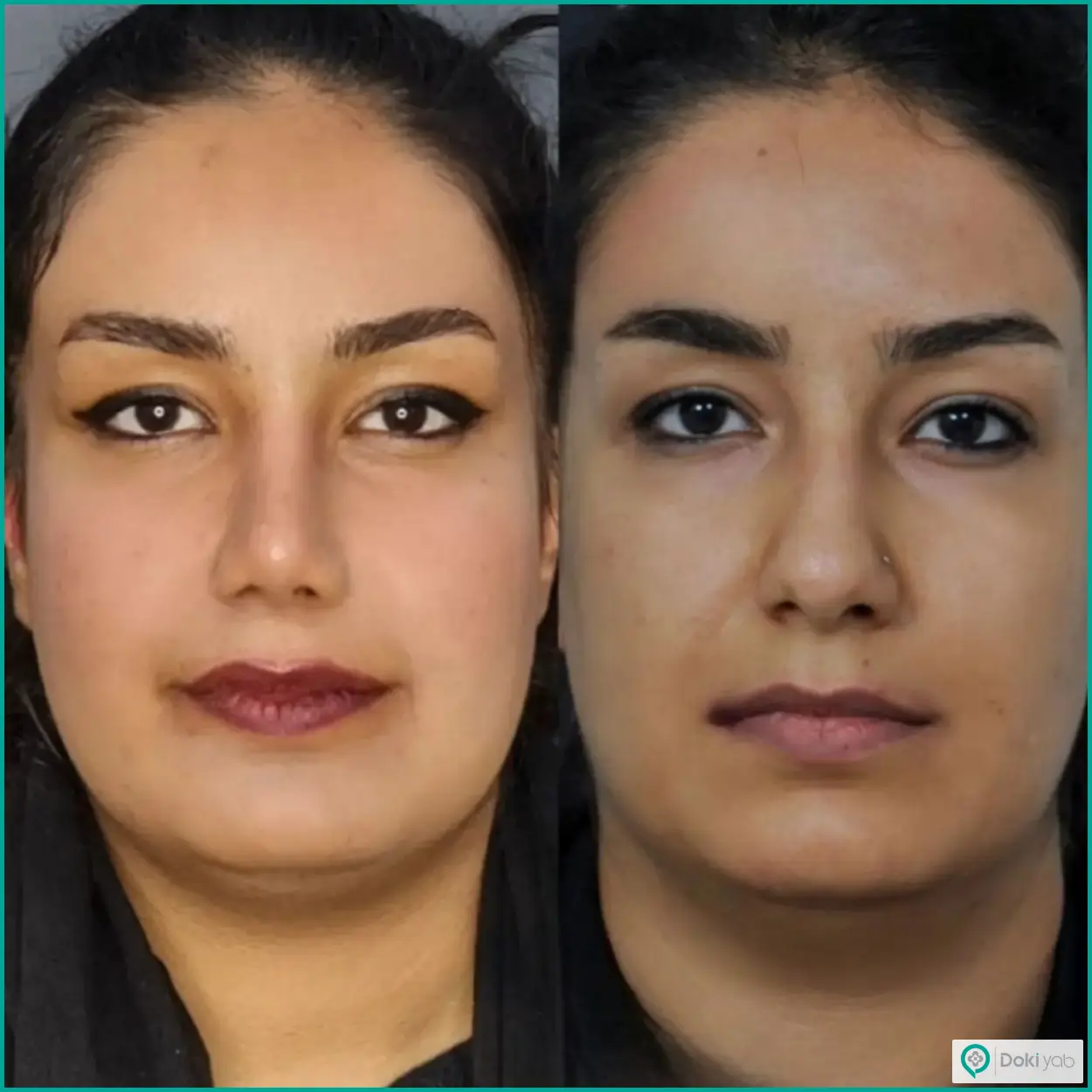 تصویر قبل و بعد جراحی بینی دکتر سعیدرضا توفیقی