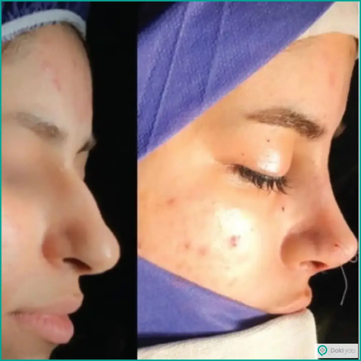 عکس قبل و بعد عمل بینی استخوانی دکتر سیاوش معتضدیان