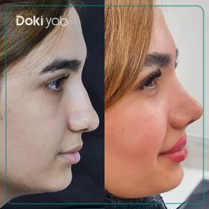 تصویر قبل و بعد عمل بینی نیمه فانتزی دکتر لیلا شریفی