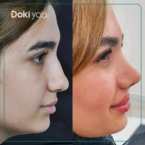 تصویر قبل و بعد عمل بینی نیمه فانتزی دکتر لیلا شریفی