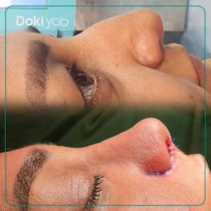 جراحی بینی به سبک نیمه فانتزی توسط دکتر بهروز گندمی