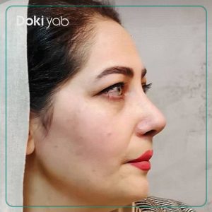 جراحی بینی به سبک نیمه فانتزی توسط دکتر نگار حعفری در شیراز