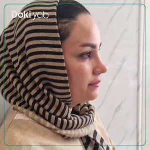 جراحی بینی طبیعی توسط دکتر آزاده مرادی در شیراز