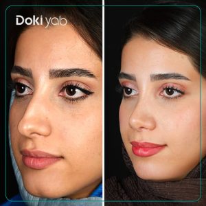 جراحی بینی طبیعی دخترانه توسط دکتر حسین دستغیب در شیراز