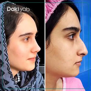 جراحی بینی طبیعی در شیراز توسط دکتر مسیح طالع