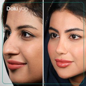 جراحی بینی فانتزی دکتر حسین دستغیب در شیراز