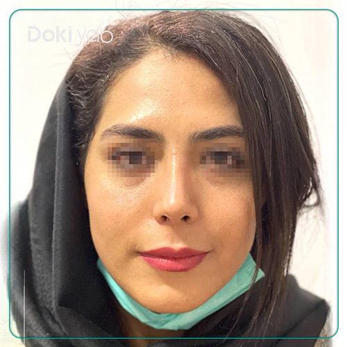جراحی بینی نچرال دکتر آرش سبحان منش در شیراز