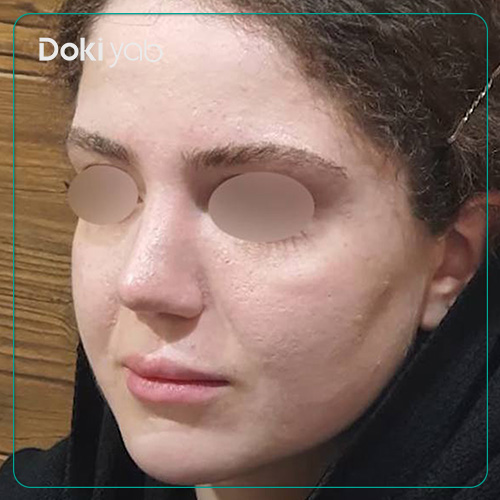 جراحی زیبایی بینی به سبک طبیعی توسط دکتر رضا کبودخانی