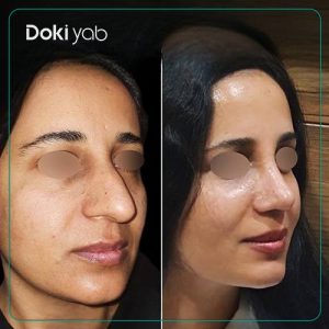 رینوپلاستی نچرال دخترانه توسط دکتر رضا کبودخانی