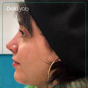 عمل بینی طبیعی زنانه توسط دکتر علیرضا مصباحی در شیراز