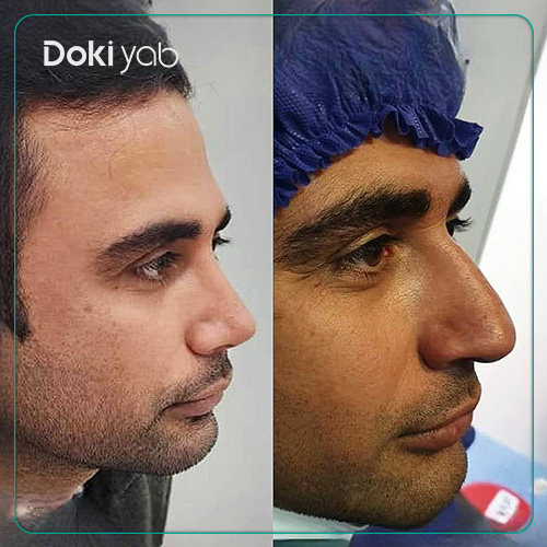 عمل بینی مردانه طبیعی دکتر بهروز گندمی