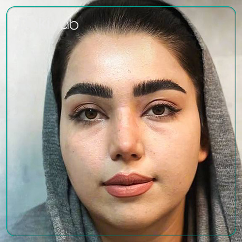 عمل بینی نیمه فانتزی نمونه کار دکتر نگار جعفری در شیراز