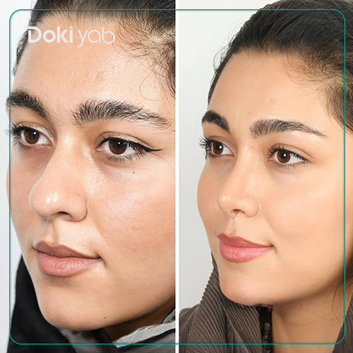 عمل بینی گوشتی طبیعی دخترانه دکتر حسین دستغیب