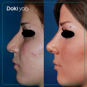عکس نمونه کار جراحی بینی طبیعی زنانه دکتر سعید مرزبان در شیراز