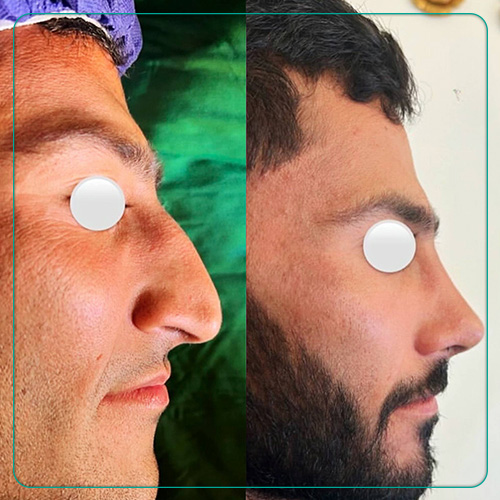 نمونه جراحی بینی استخوانی مردانه دکتر امین میراحمدی در شیراز