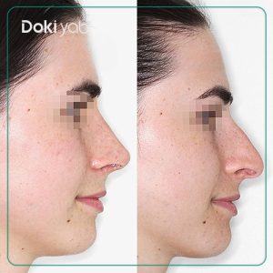 نمونه جراحی بینی دکتر وحید عین آبادی در شیراز