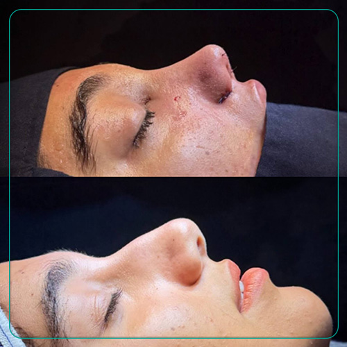 نمونه جراحی بینی طبیعی دکتر امین میراحمدی در شیراز