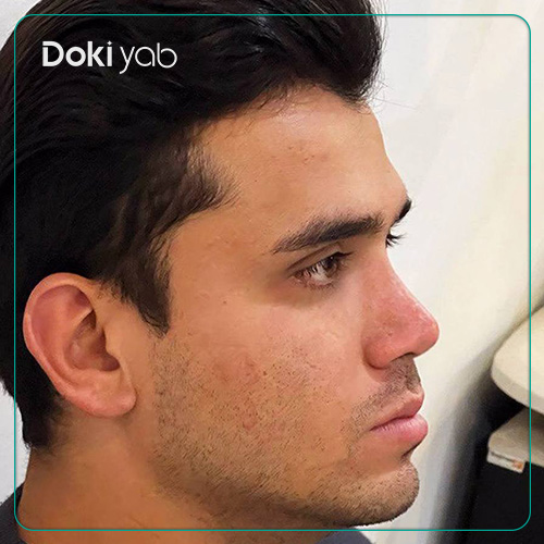 نمونه جراحی بینی طبیعی مردانه توسط دکتر شهریار شاهمرادی