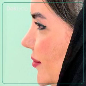 نمونه جراحی بینی فانتزی دکتر آمیتیس نوذری جراح بینی در شیراز