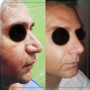 نمونه جراحی بینی مردانه طبیعی حشمت الله حقوقی دکتر عمل بینی در شیراز