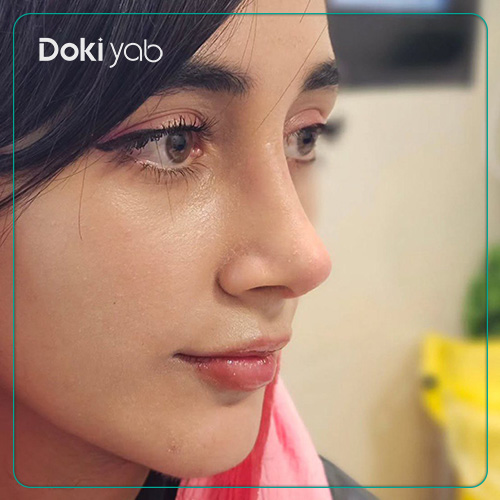 نمونه جراحی بینی نیمه فانتزی دکتر امیر خسرو برخورداری در شیراز