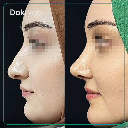 نمونه جراحی بینی نیمه فانتزی دکتر وحید عین آبادی در شیراز
