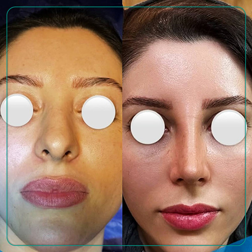 نمونه جراحی زیبایی بینی دکتر امین میراحمدی در شیراز
