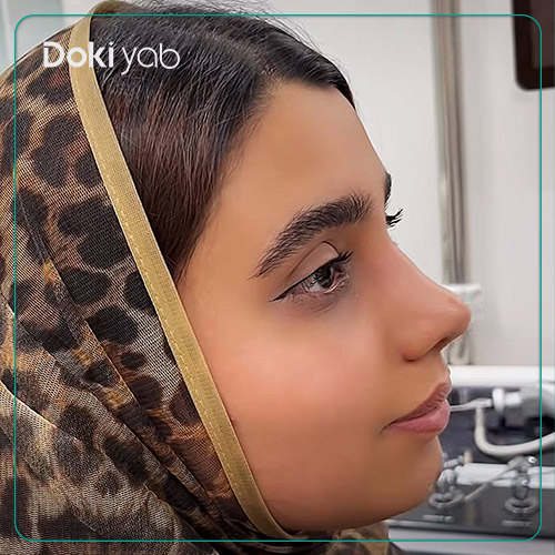 نمونه جراحی زیبایی بینی دکتر لیلا شریفی