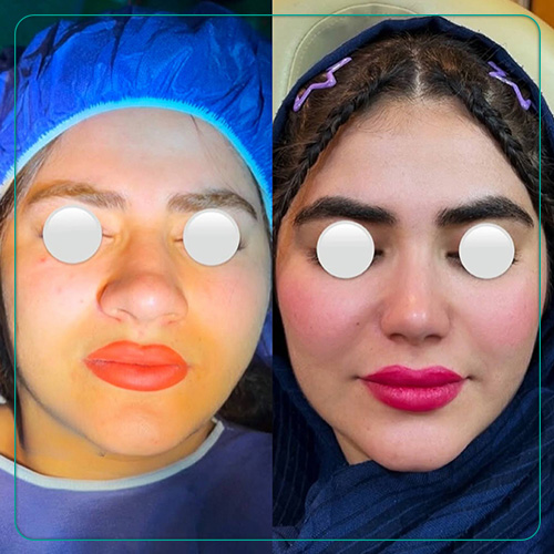 نمونه جراحی زیبایی بینی زنانه دکتر امین میراحمدی در شیراز