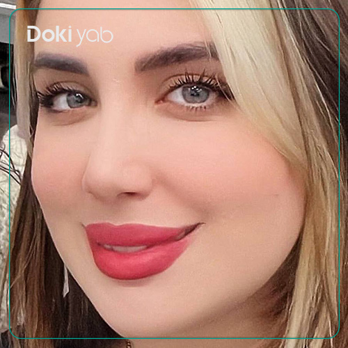 نمونه جراحی طبیعی بینی زنانه نیمه فانتزی دکتر سعید مرزبان در شیراز