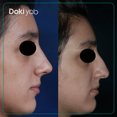 نمونه جراحی طبیعی بینی مردانه دکتر سعید مرزبان در شیراز