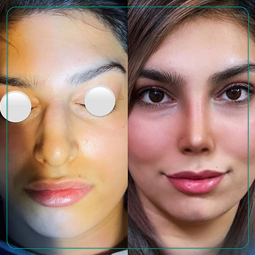 نمونه رینوپلاستی دکتر امین میراحمدی در شیراز