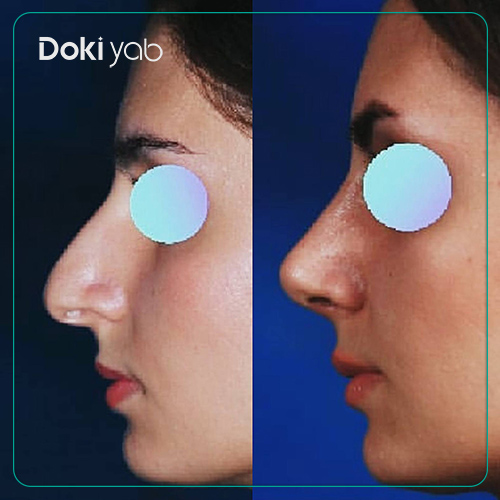 نمونه رینوپلاستی طبیعی زنانه دکتر سعید مرزبان جراح بینی در شیراز