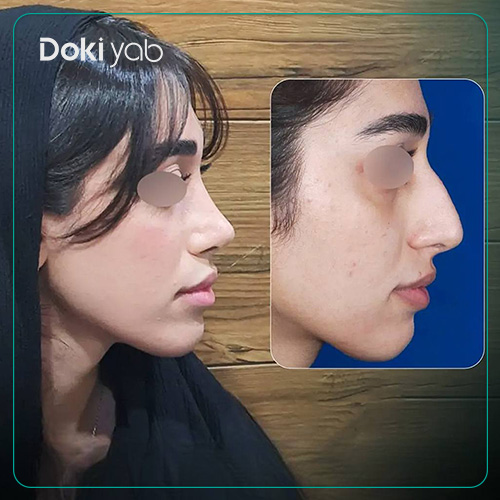 نمونه عمل بینی استخوانی دکتر رضا کبودخانی