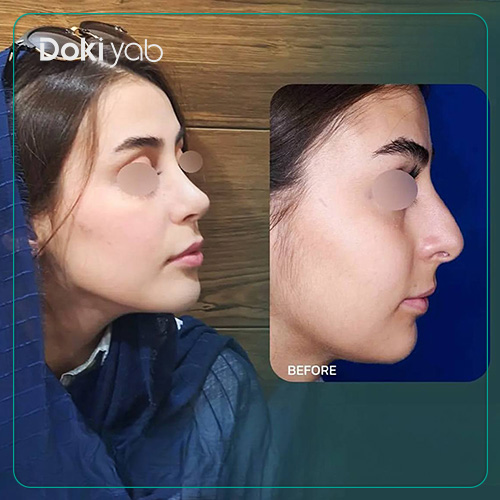 نمونه عمل بینی استخوانی طبیعی دکتر رضا کبودخانی