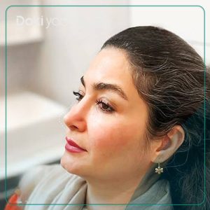 نمونه عمل بینی به سبک نچرال توسط دکتر لیلا اسدپور در شیراز
