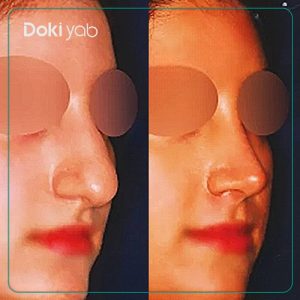 نمونه عمل بینی دکتر بیژن ربیعی جراح بینی در شیرازَ