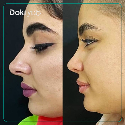 نمونه عمل بینی دکتر زهرا خسروی در شیراز به سبک نیمه فانتزی