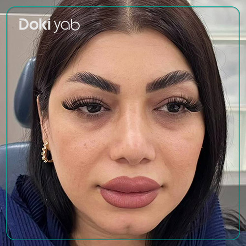 نمونه عمل بینی طبیعی دکتر لیلا شریفی