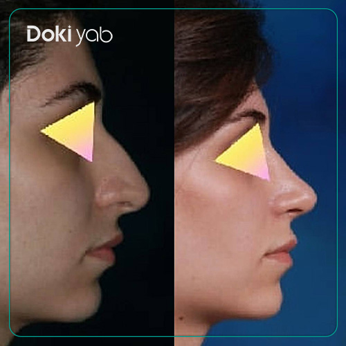 نمونه عمل بینی طبیعی زنانه دکتر سعید مرزبان جراح بینی در شیراز