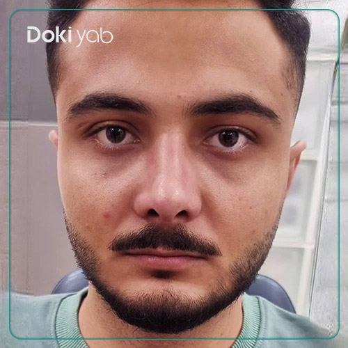 نمونه عمل بینی طبیعی مردانه دکتر لیلا شریفی