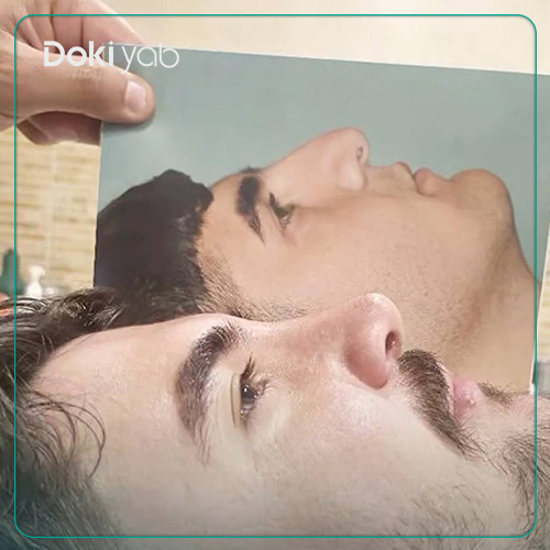 نمونه عمل بینی مردانه دکتر آزاده مرادی در شیراز
