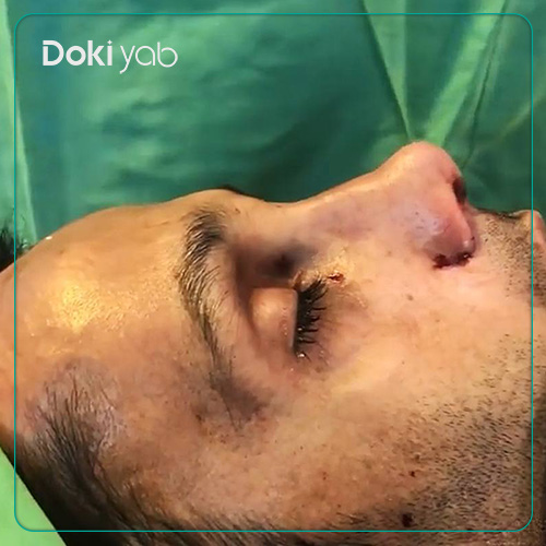 نمونه عمل بینی مردانه دکتر سعید مرزبان جراح بینی در شیراز