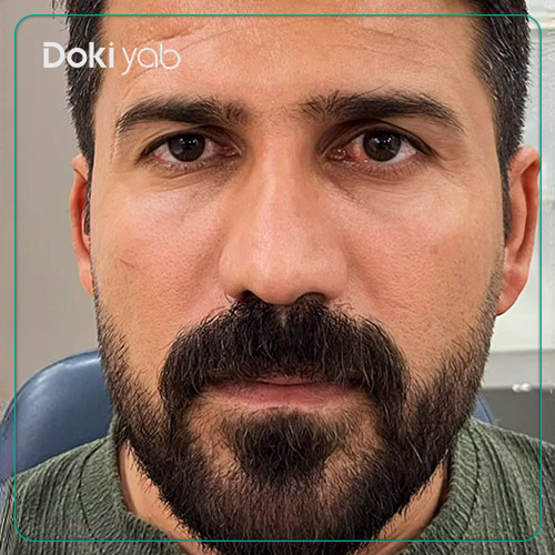 نمونه عمل بینی مردانه دکتر لیلا شریفی جراح بینی در شیراز