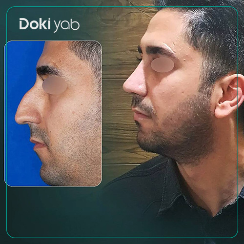 نمونه عمل بینی مردانه طبیعی دکتر رضا کبودخانی